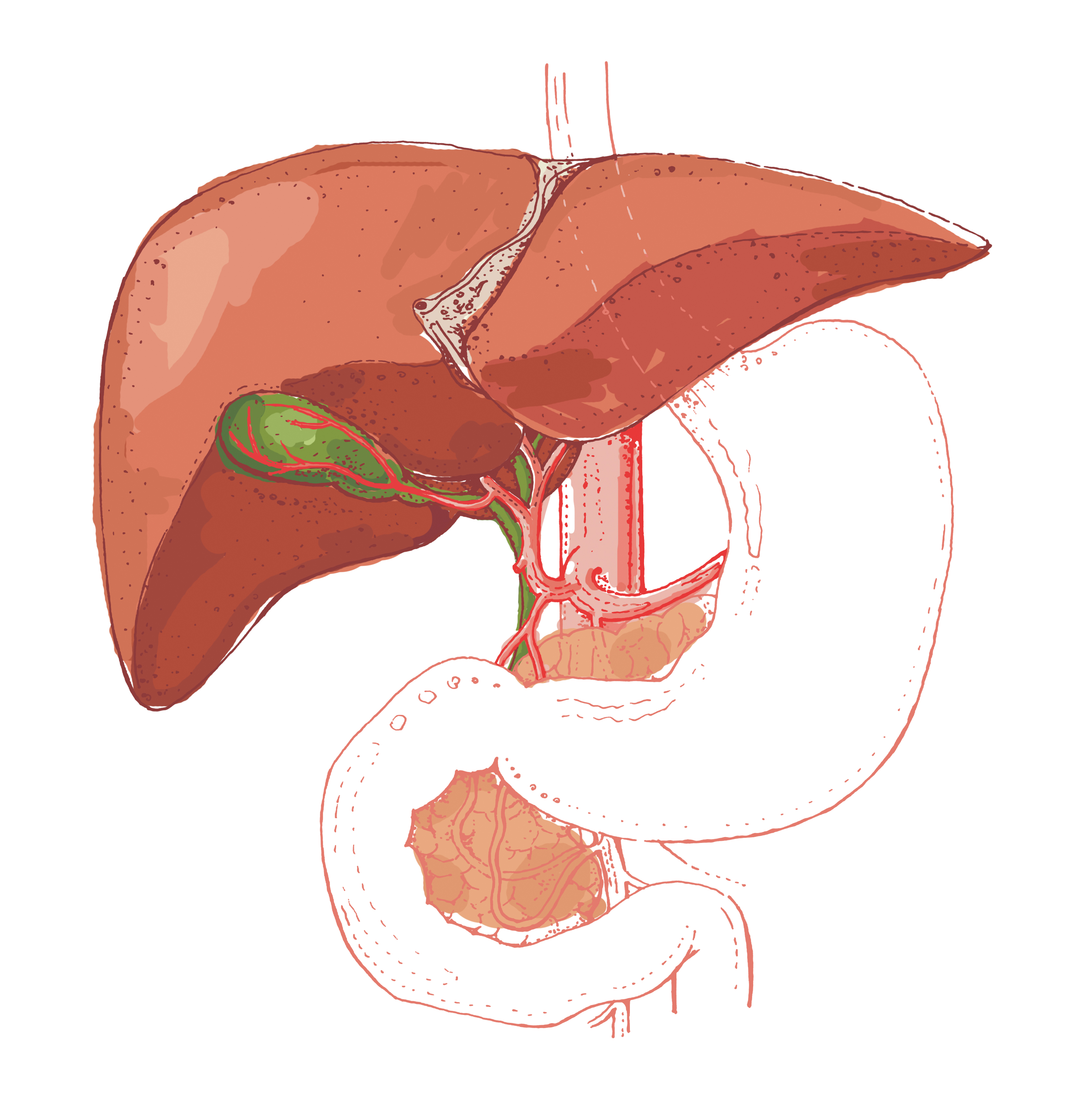 Nichole's Gallbladder Journey